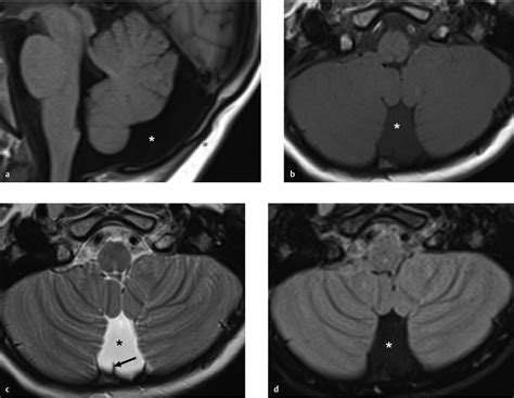 mega cisterna magna radiology|mega cisterna magna adult.